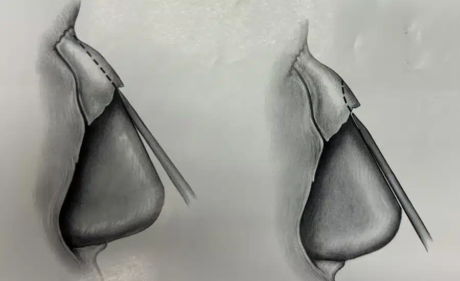 Rhinoplasty technique diagram &mdash; nasal tip suturing (interdomal sutures)