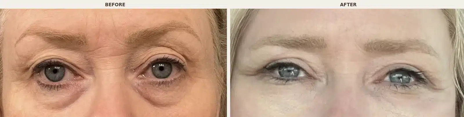 Close-up before and after of the eye area following upper blepharoplasty, Bellafill browlift, and tear trough treatment