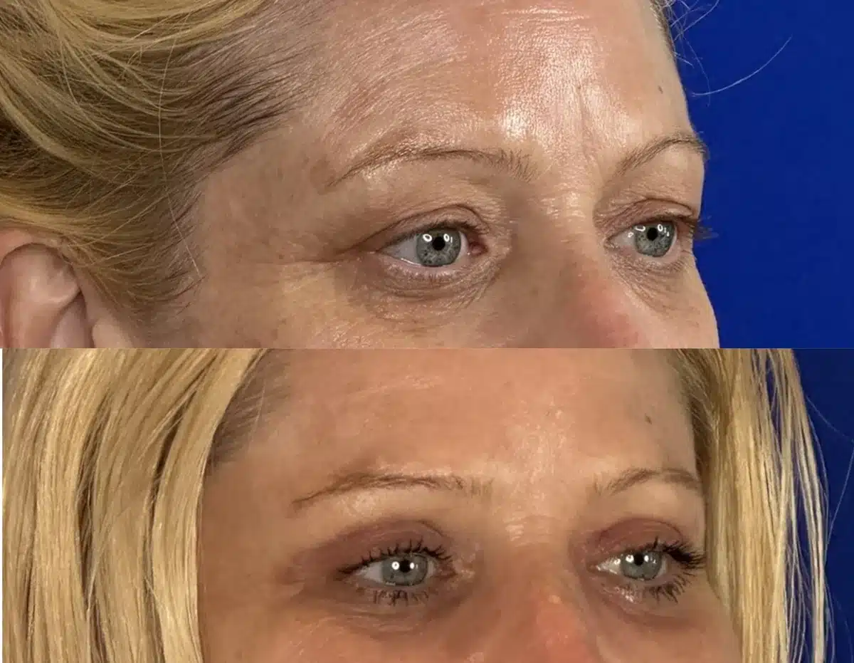 Upper blepharoplasty before & after, oblique view &mdash; Patient 15 &mdash; Upper Blepharoplasty