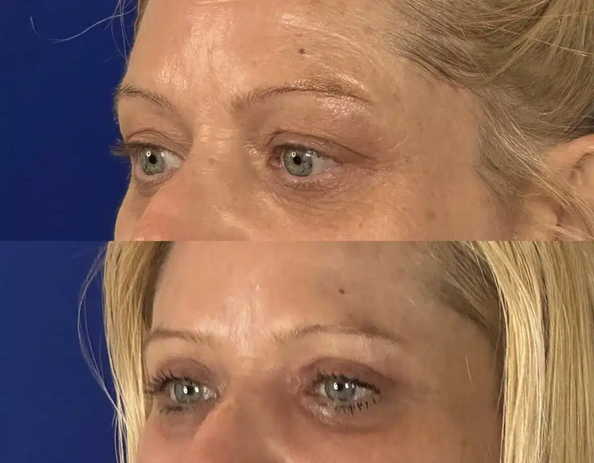 Upper blepharoplasty before & after, three-quarter view &mdash; Patient 15 &mdash; Upper Blepharoplasty