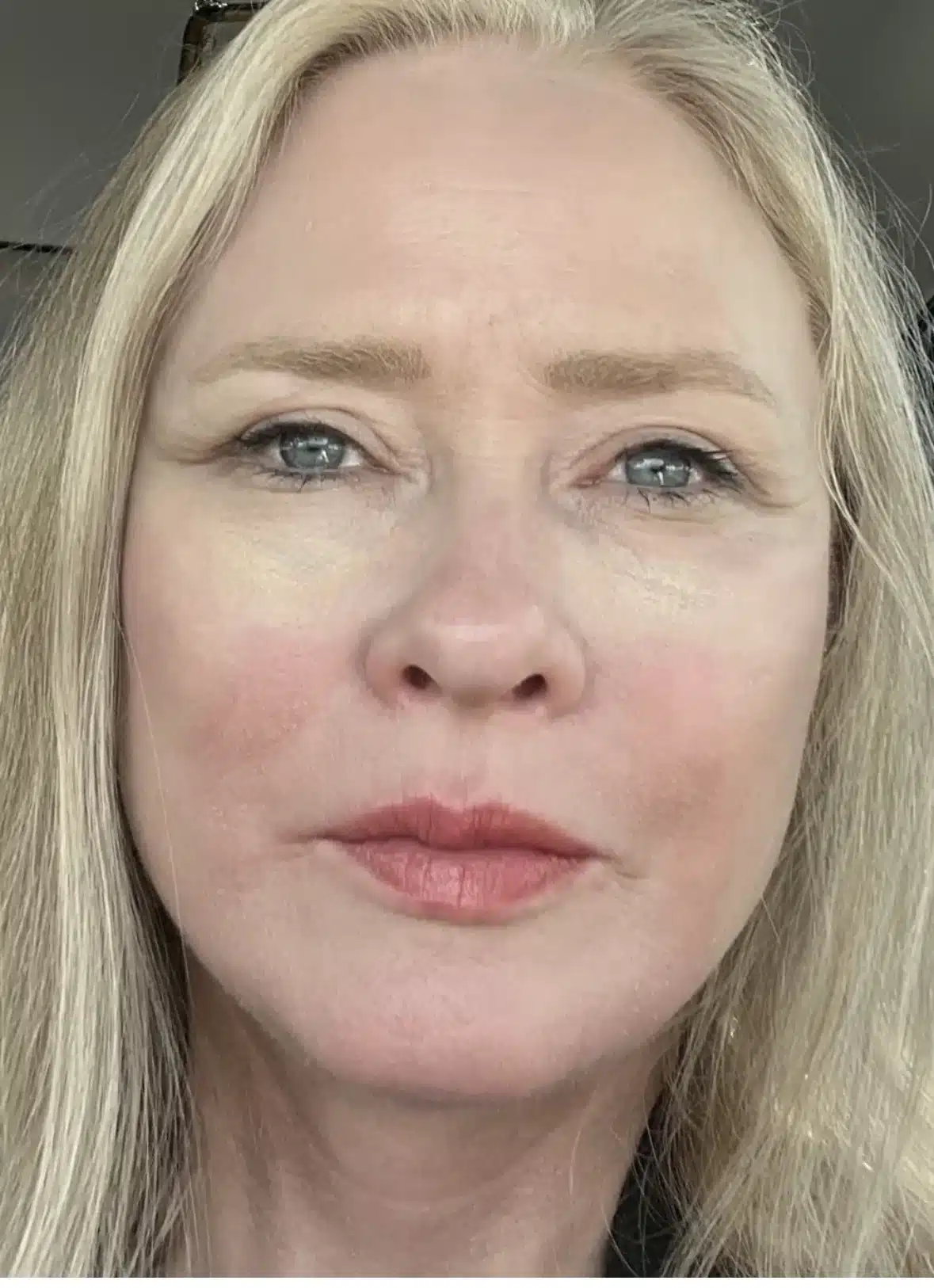 After permanent cheek volume restoration with fuller midface &mdash; actual patient, Las Vegas