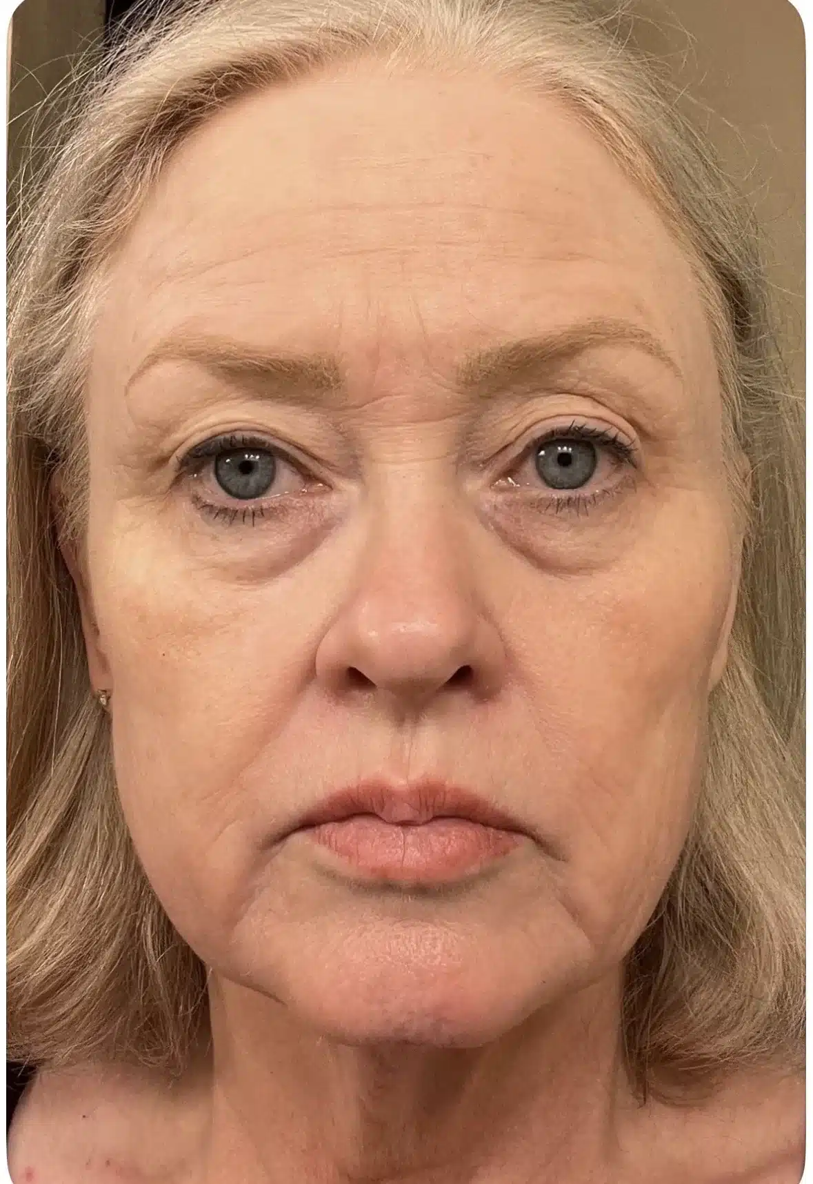 Before permanent cheek volume restoration &mdash; actual patient of Dr. Robert Troell, Las Vegas