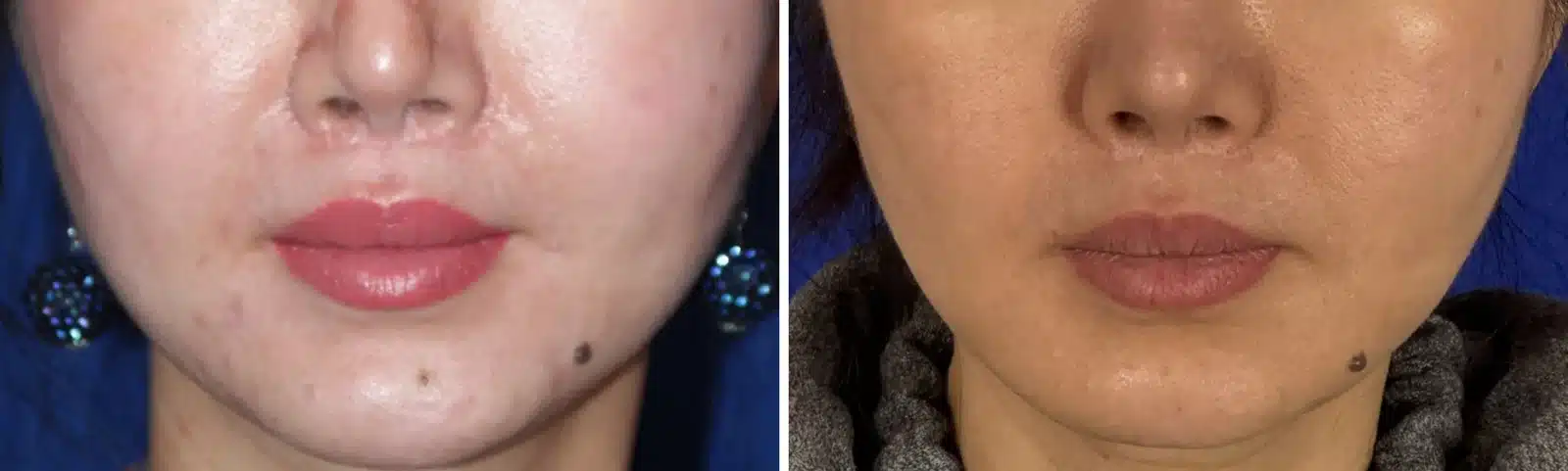 Bellafill before and after, front view &mdash; the nasolabial fold beside the mouth is softer after Bellafill injections by Dr. Robert J. Troell in Las Vegas. Actual patient; individual results vary.