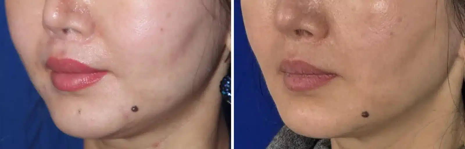 Bellafill before and after, left three-quarter view &mdash; the nasolabial fold beside the mouth is softer after Bellafill injections by Dr. Robert J. Troell in Las Vegas. Actual patient; individual results vary.
