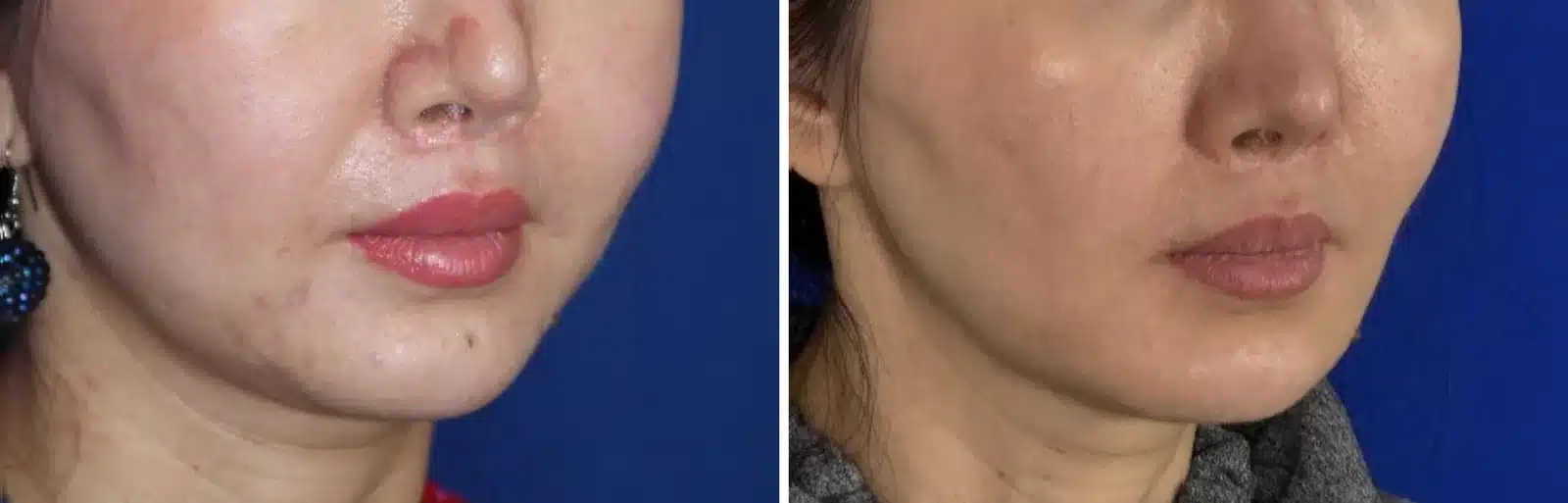 Bellafill before and after, right three-quarter view &mdash; the nasolabial fold beside the mouth is softer after Bellafill injections by Dr. Robert J. Troell in Las Vegas. Actual patient; individual results vary.