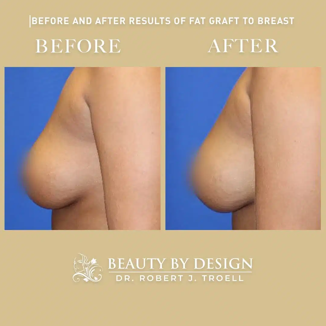 Breast fat grafting before and after, side profile &mdash; fuller upper-pole volume and improved projection after fat grafting to the breast by Dr. Robert J. Troell in Las Vegas