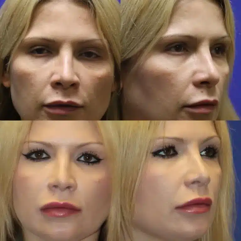 Cheek Fillers Las Vegas | Cheek Augmentation for Volume Loss