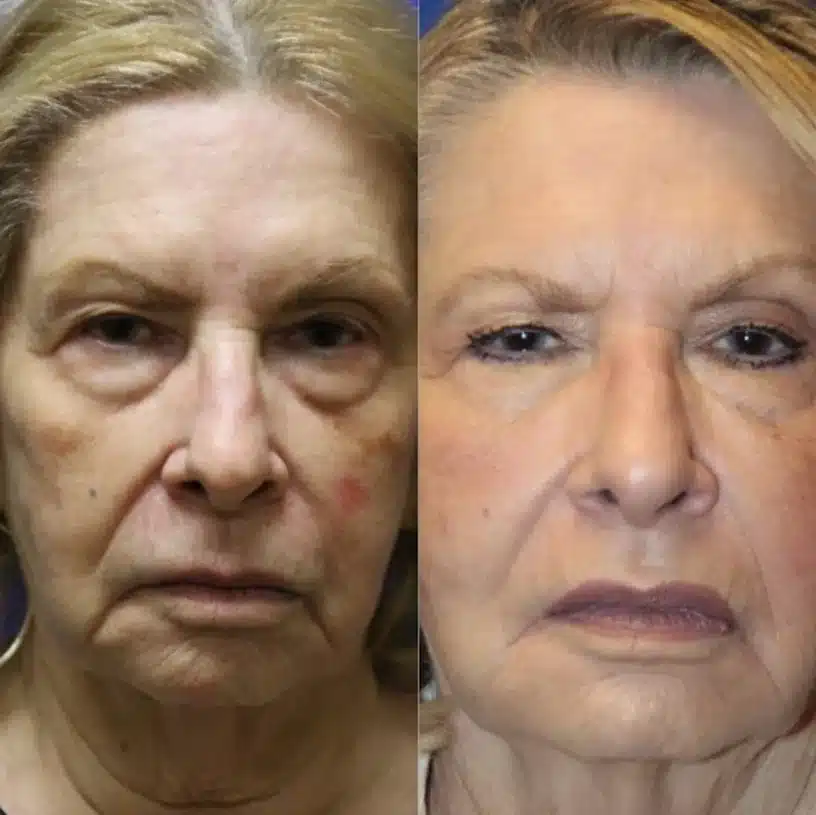 Before and after midface volume restoration with dermal filler, front view &mdash; actual patient, Las Vegas