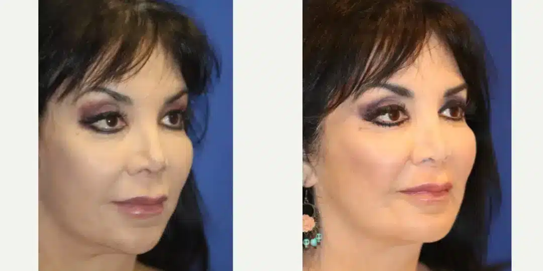 Chin implant before & after, left oblique view &mdash; Patient 5 &mdash; Chin Implant