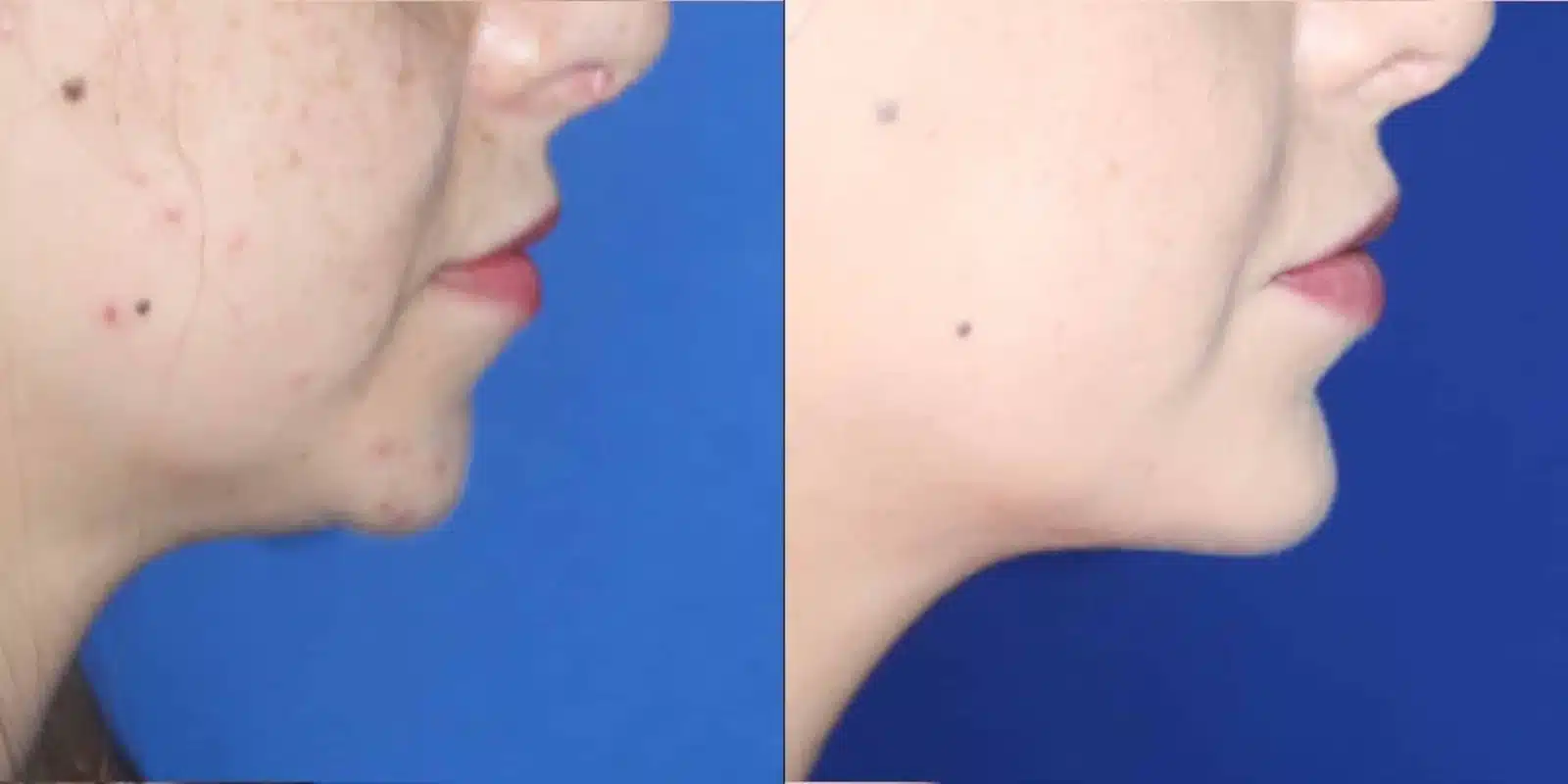 Chin implant before and after, right profile &mdash; a young woman's under-projected chin gains forward projection and a defined chin-to-neck transition after chin implant surgery by Dr. Robert J. Troell, Las Vegas. Actual patient; individual results vary.