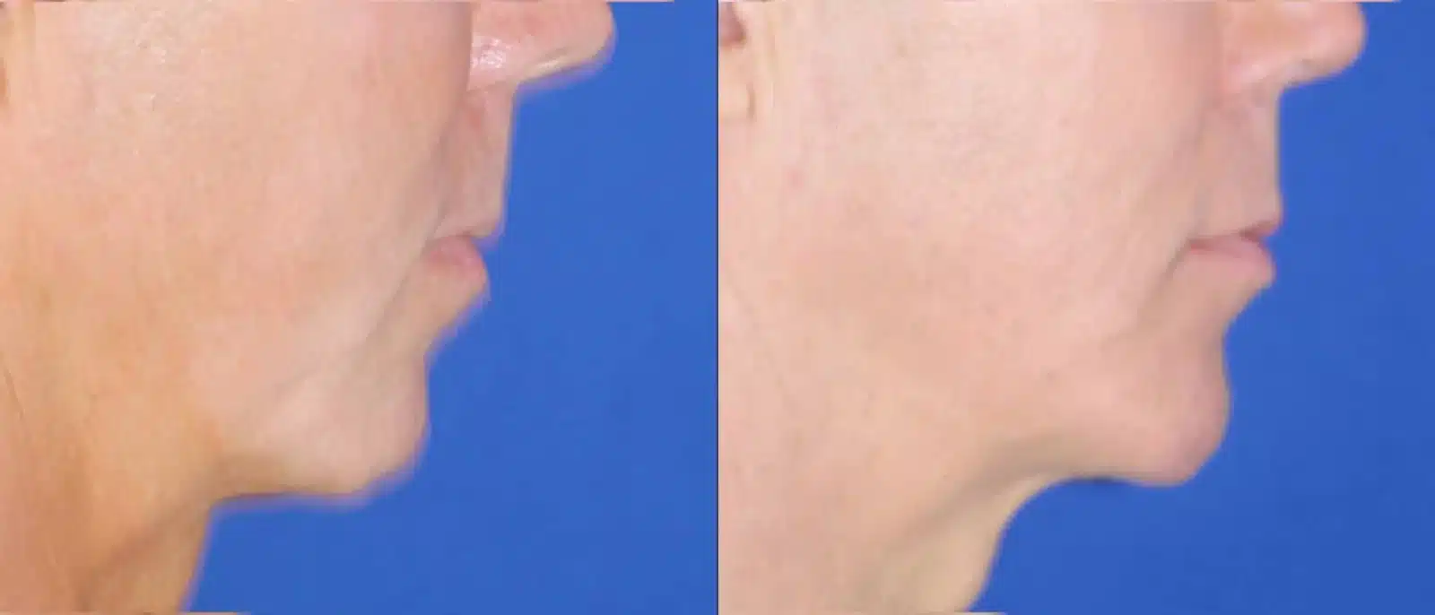Chin implant before and after, right profile &mdash; a receding chin and soft jaw-to-neck line before, firmer forward chin projection and a cleaner jawline after chin implant surgery by Dr. Robert J. Troell, Las Vegas. Actual patient; individual results vary.