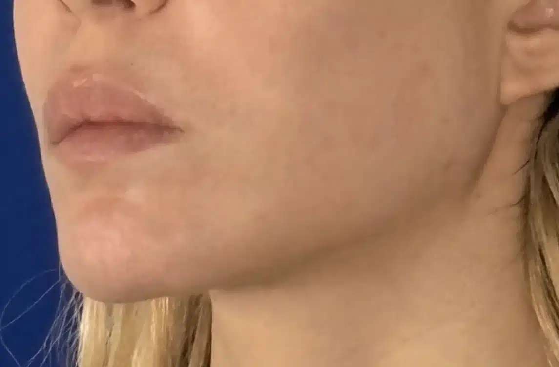 After chin and jawline augmentation, left oblique close-up &mdash; a deliberately subtle improvement in chin projection and jawline definition. Actual patient in Las Vegas; individual results vary