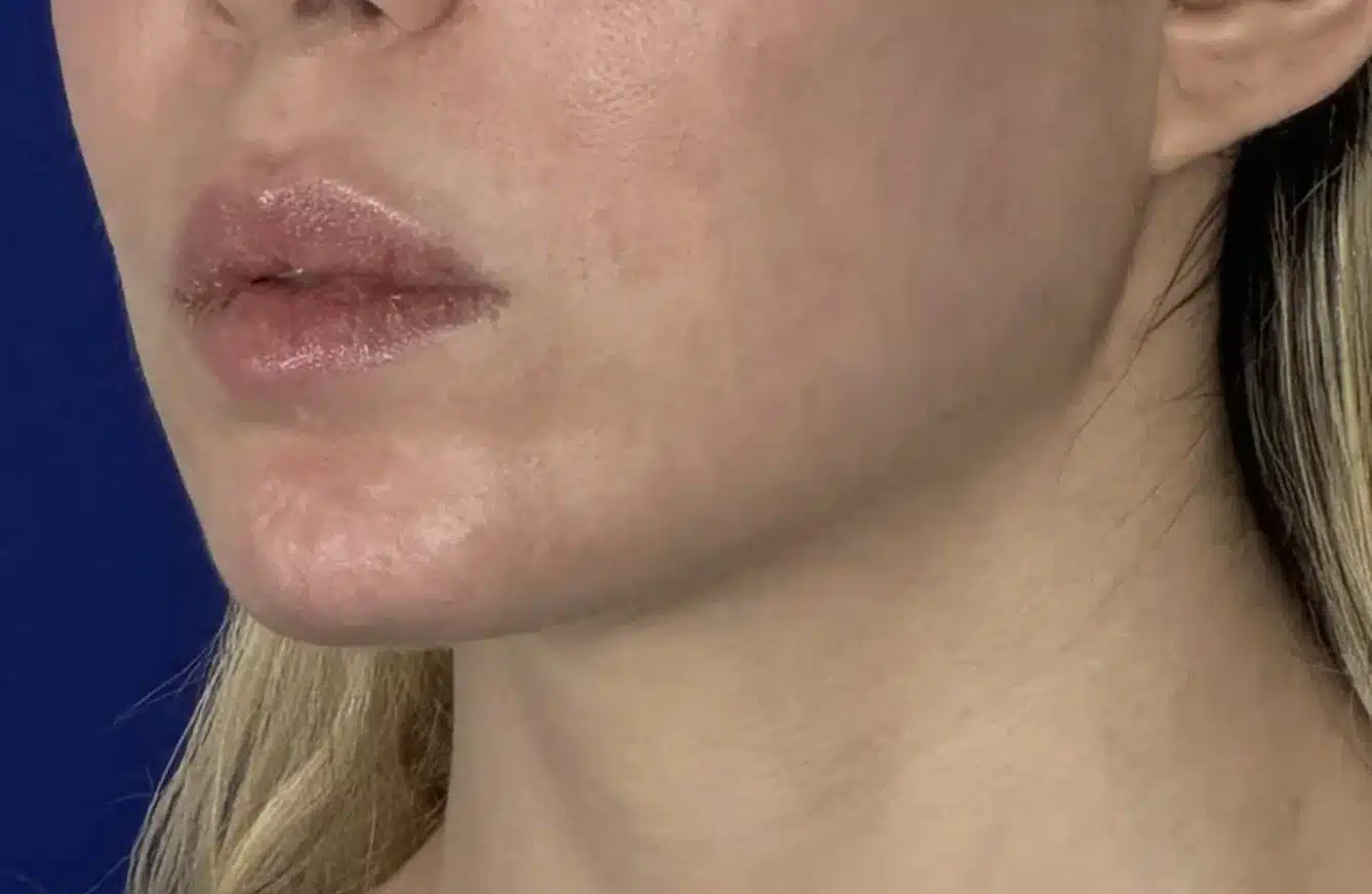 Before chin and jawline augmentation, left oblique close-up &mdash; softer chin projection and jaw-to-neck transition prior to surgery. Actual patient in Las Vegas