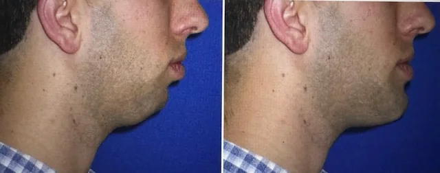 Chin and jawline augmentation before and after, right profile &mdash; a male patient's chin projection and jawline definition are improved. Actual patient in Las Vegas; individual results vary