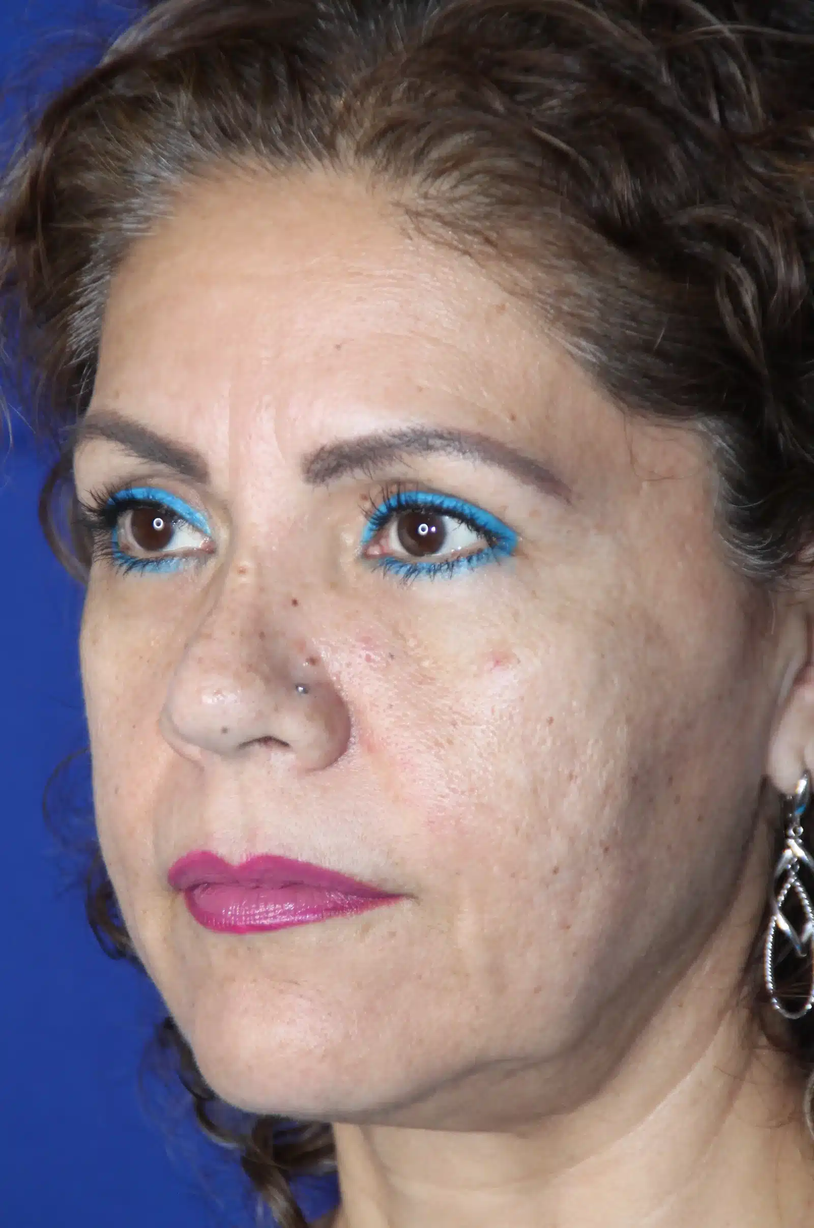 Before CO2 laser resurfacing, oblique view: acne scarring, sun damage and freckling &mdash; actual patient of Dr. Robert Troell, Las Vegas