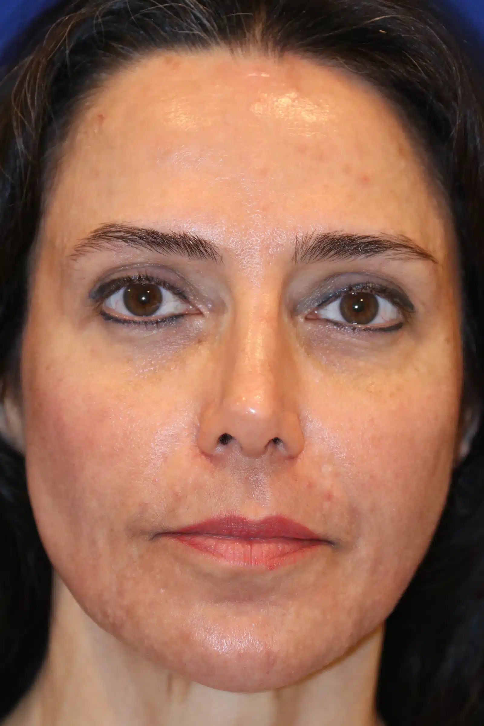Early healing after CO2 laser resurfacing: faint redness resolving about one week after treatment &mdash; actual patient, Las Vegas