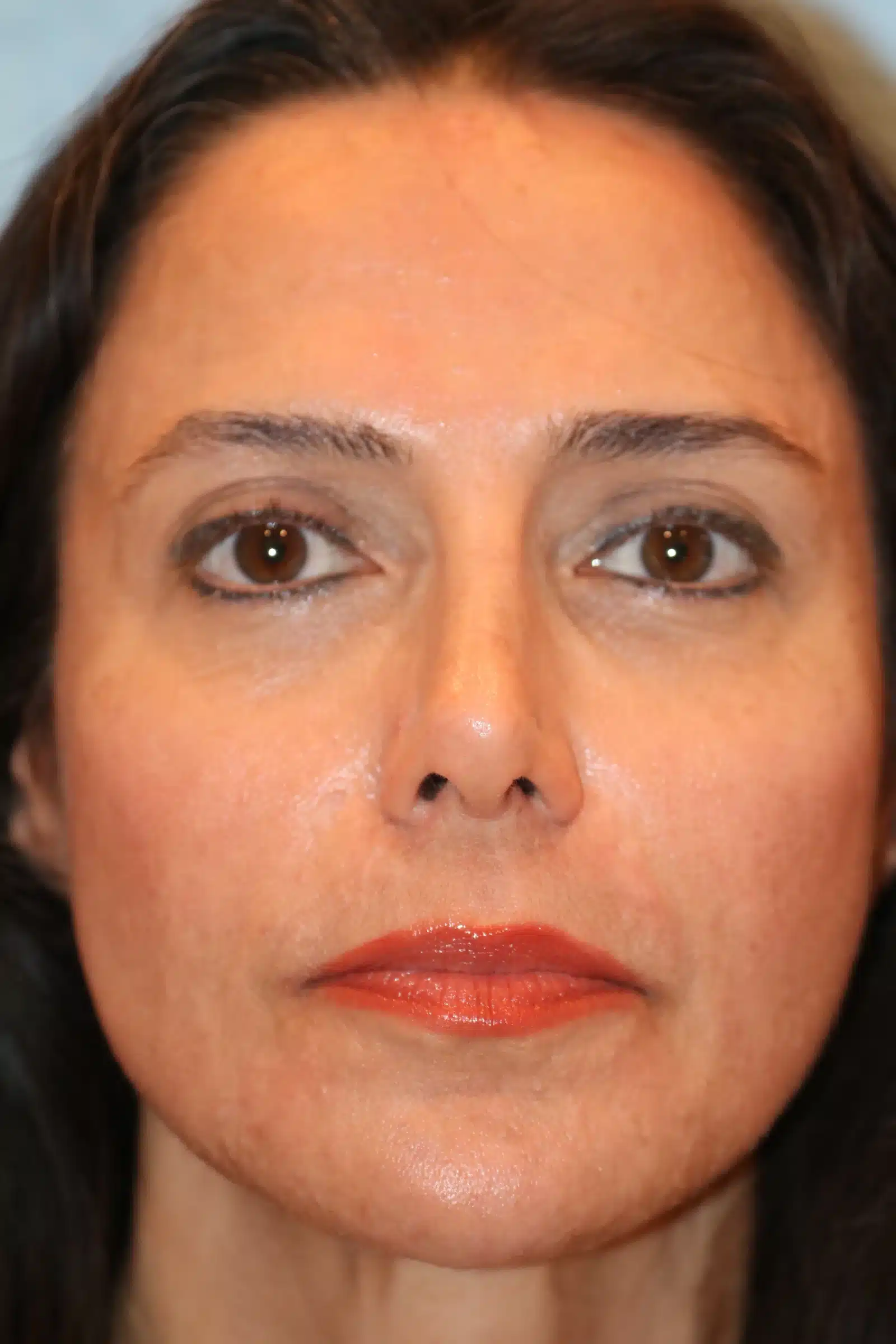 Healed result after CO2 laser skin resurfacing: smooth, even skin tone &mdash; actual patient, Las Vegas