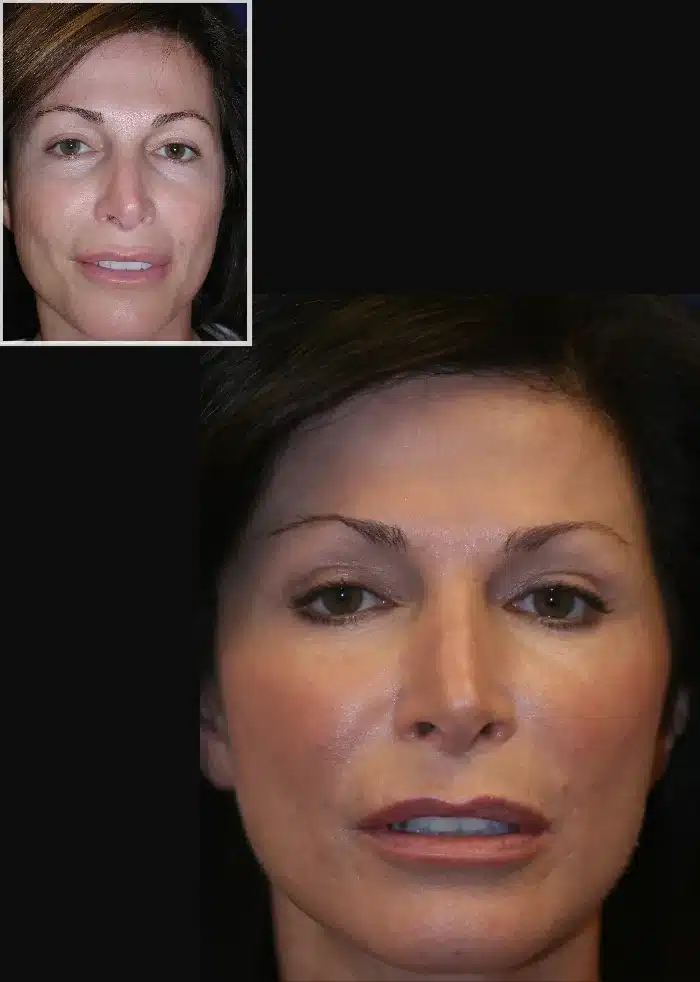 CO2 Laser Skin Resurfacing Las Vegas | What to Expect