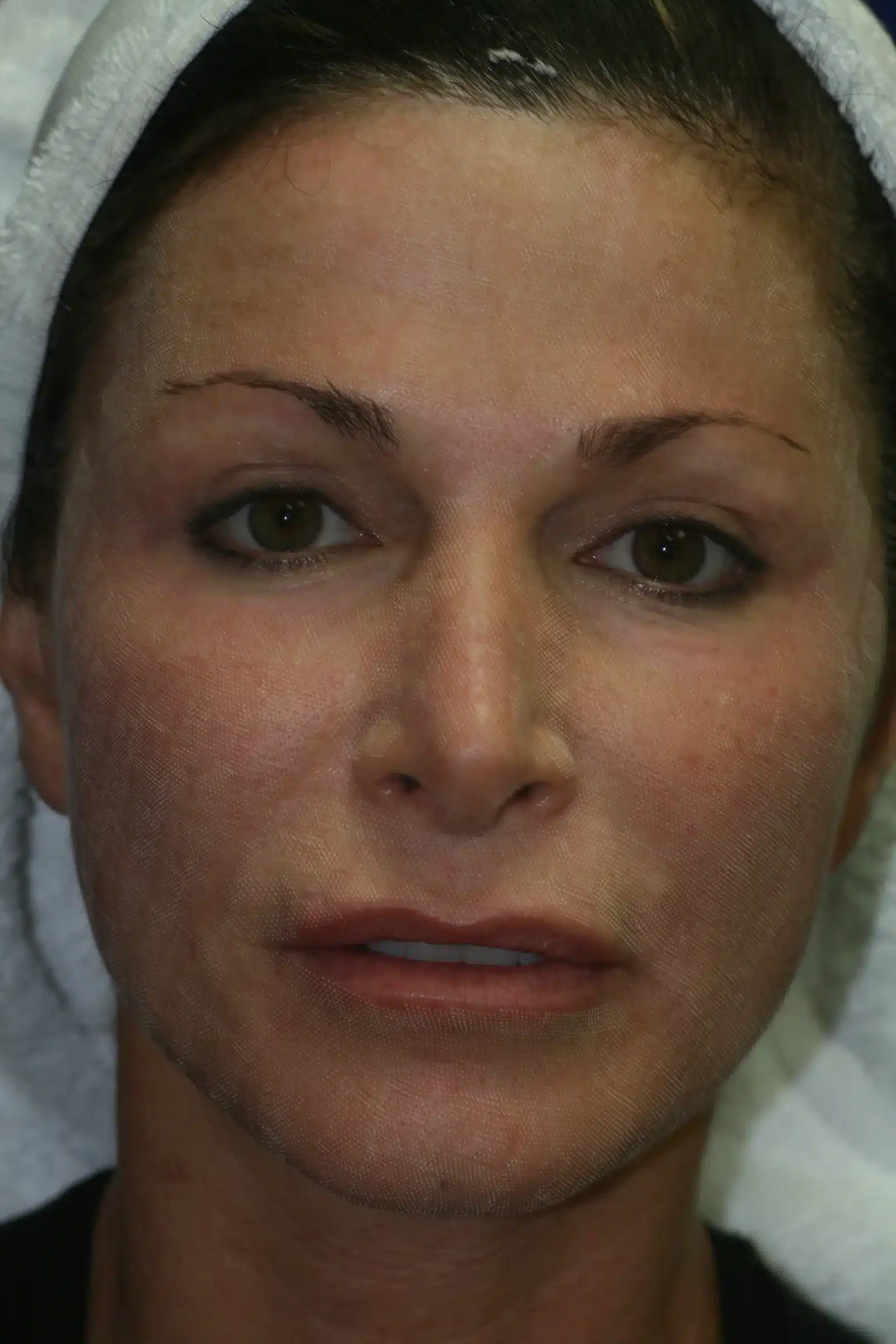 Immediately after fractional CO2 laser skin resurfacing: the microscopic treatment-zone grid pattern visible with mild redness &mdash; Beauty by Design, Las Vegas