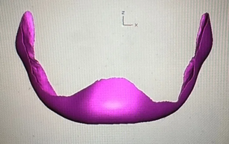 Custom Jawline Implants: Are They Right for You?