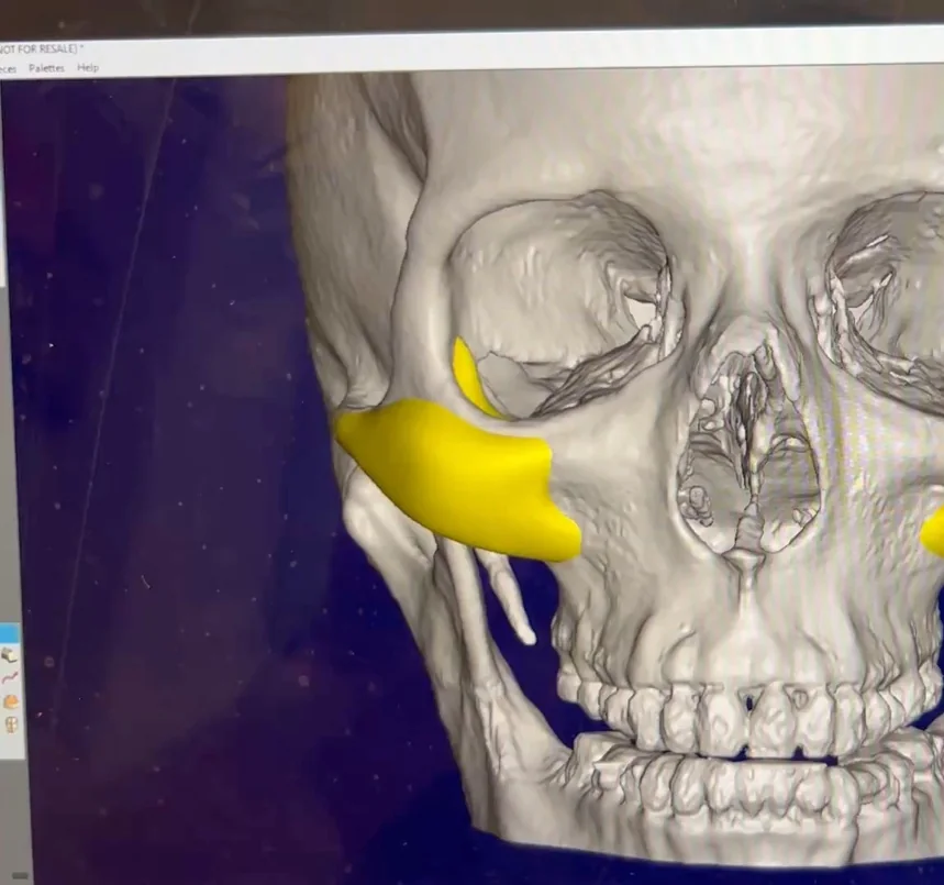 Design-session view of a custom malar implant, shown in yellow over the patient's 3D CT reconstruction during engineering planning