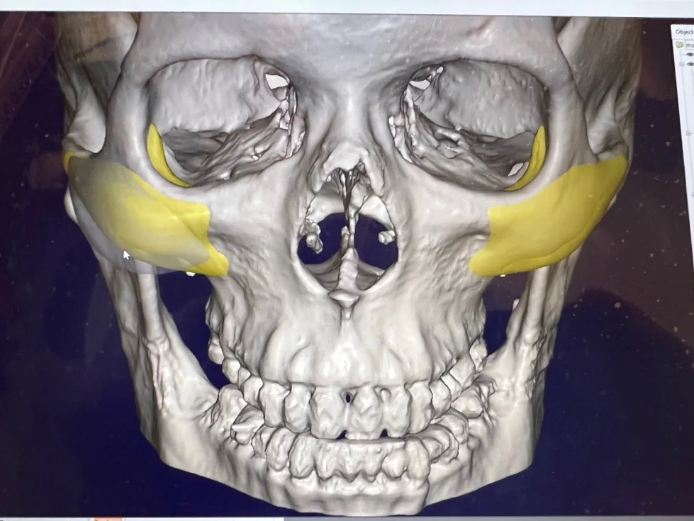 Custom midface implant design shown in yellow over a patient's 3D CT scan reconstruction, front view &mdash; designing a malar implant from the patient's own bone structure