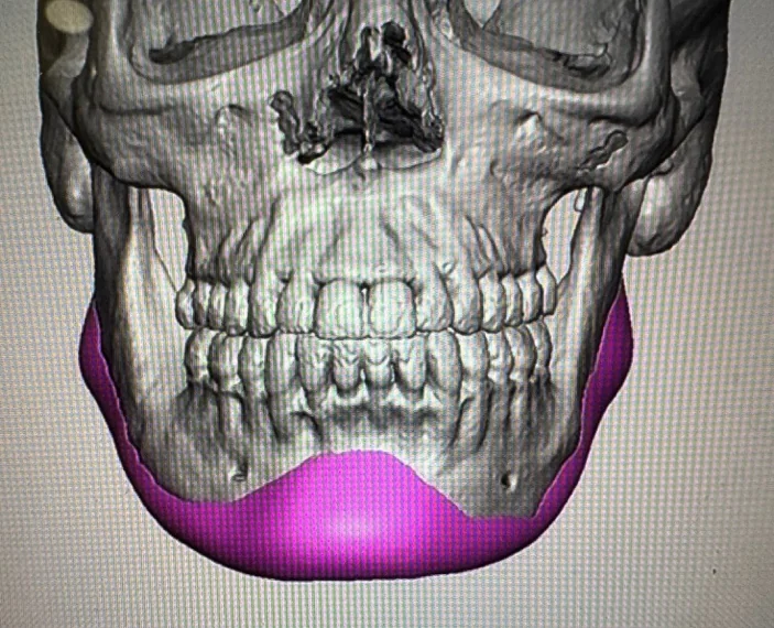 Custom wrap-around jawline implant design shown in pink over a patient's 3D CT reconstruction, front view &mdash; the implant is engineered to the patient's own mandible