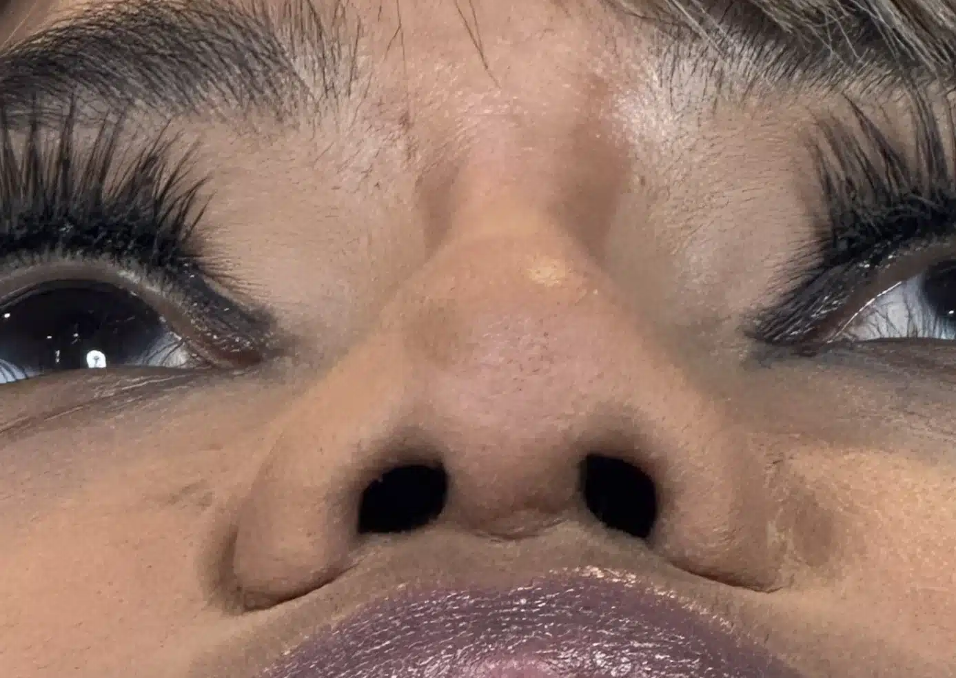 After ethnic rhinoplasty, base view: narrowed nasal base approaching an equilateral triangle after alar base reduction and tip graft &mdash; actual patient, Las Vegas