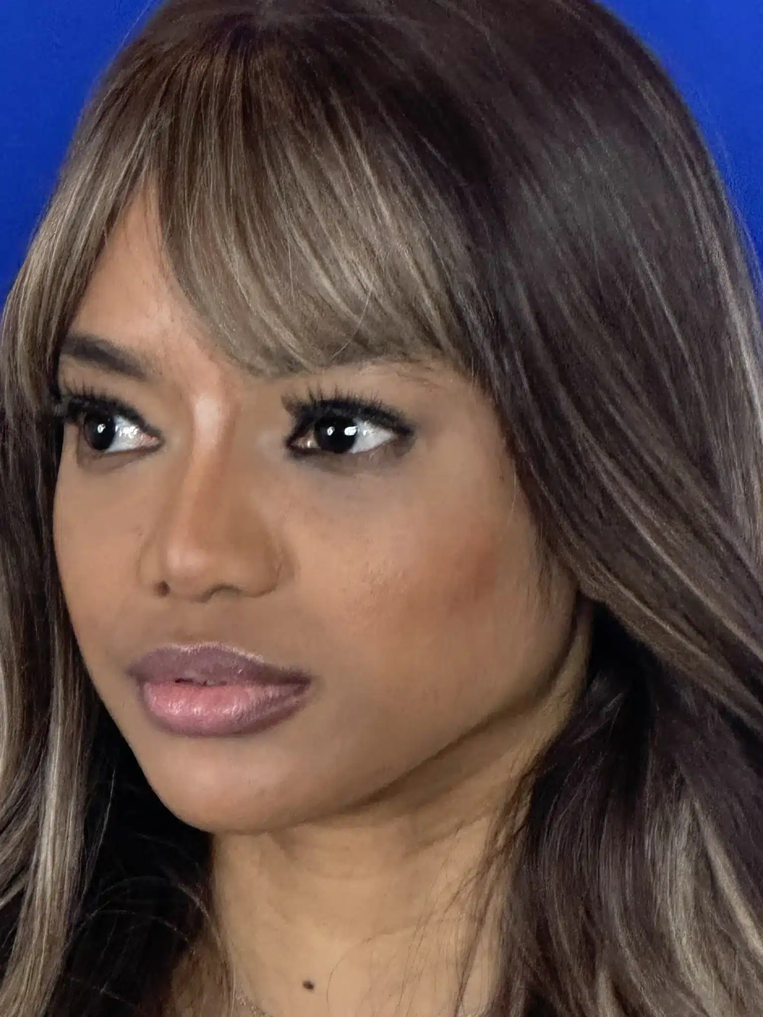 After ethnic rhinoplasty, left oblique view: heightened bridge with the patient's ethnic identity preserved &mdash; actual patient, Las Vegas