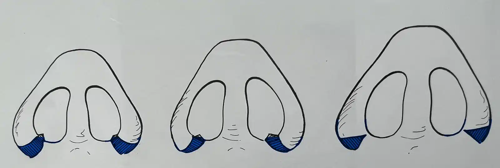 Hand-drawn surgical illustration by Dr. Robert Troell showing three stages of alar base reduction &mdash; the wedge of skin removed at each nostril base to narrow a wide nasal base &mdash; Troell Cosmetic Surgery, Las Vegas