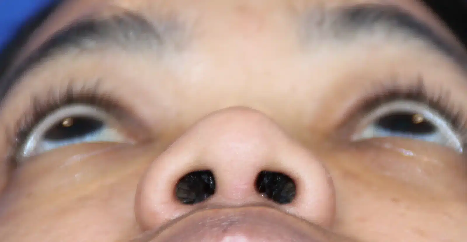 Before ethnic rhinoplasty, base view: wide nasal base and rounded tip prior to alar base reduction &mdash; Troell Cosmetic Surgery, Las Vegas