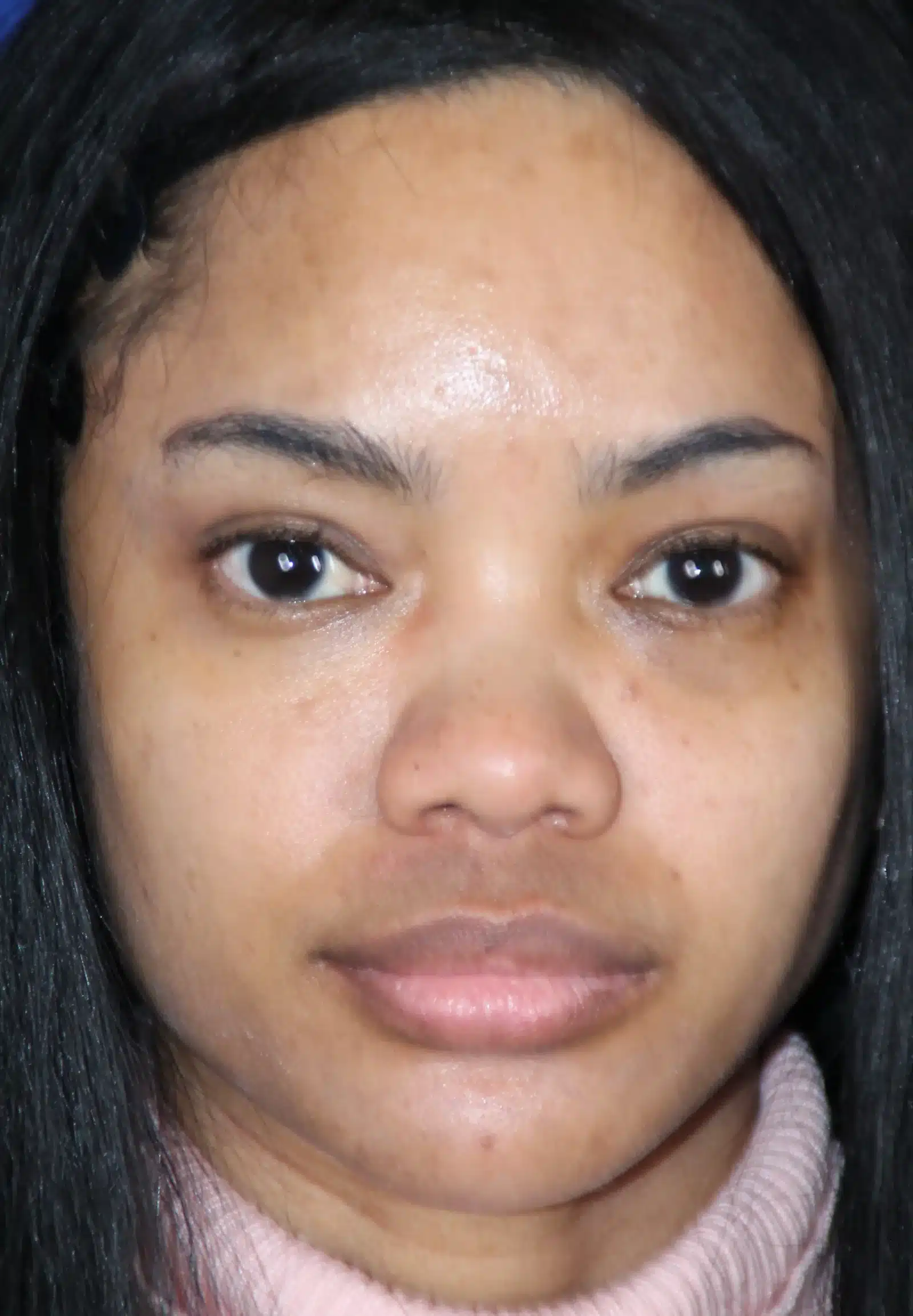 Before ethnic rhinoplasty, front view: young woman of Afro-American and Asian heritage with a flat, wide nasal bridge and wide rounded tip &mdash; Troell Cosmetic Surgery, Las Vegas
