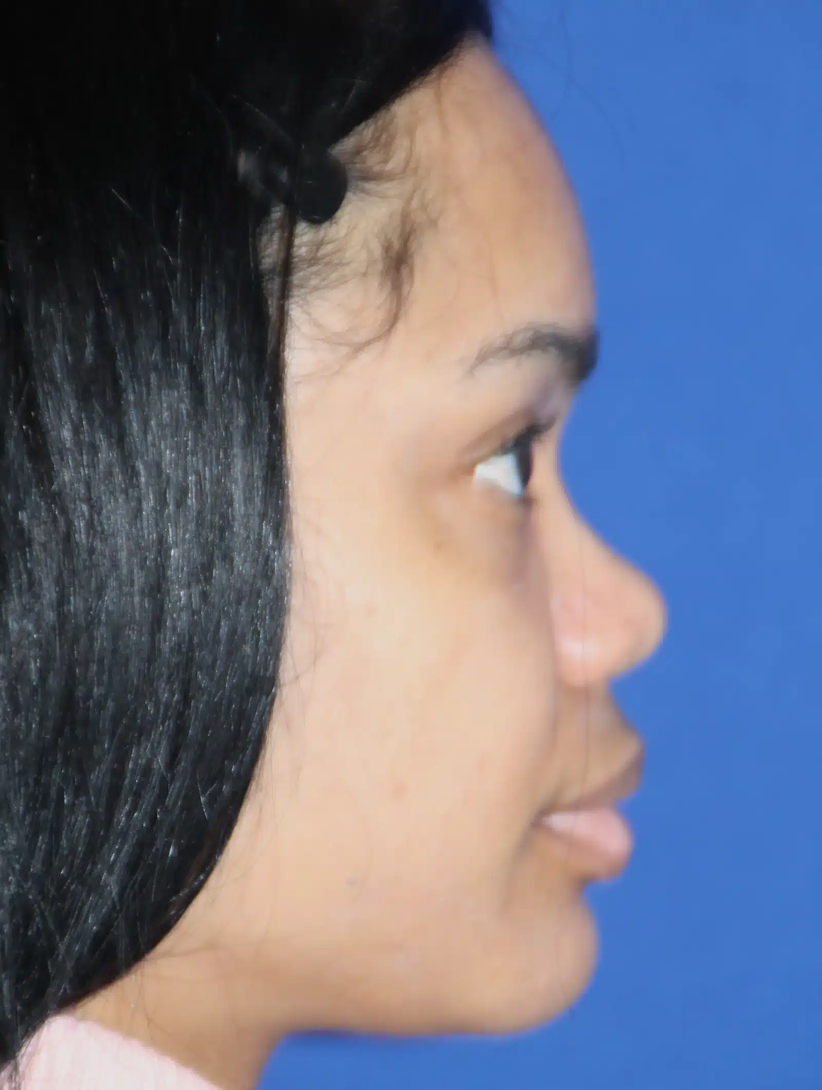 Before ethnic rhinoplasty, right profile: low nasal bridge and under-projected tip prior to augmentation rhinoplasty &mdash; Troell Cosmetic Surgery, Las Vegas