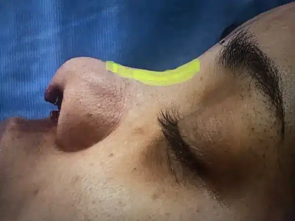 Intraoperative view with the dorsal nasal implant position highlighted on the bridge during augmentation rhinoplasty &mdash; Troell Cosmetic Surgery, Las Vegas