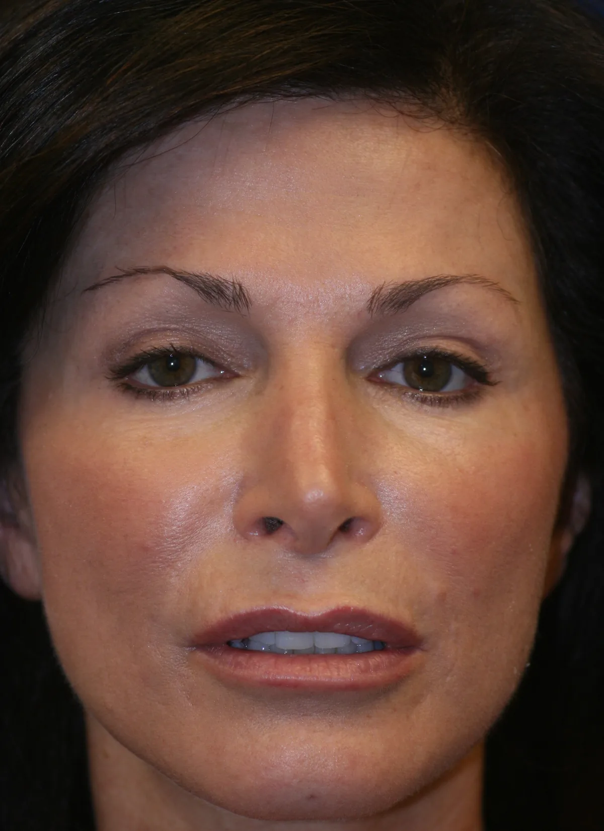 After photo, front view &mdash; the same patient after combined eyelid rejuvenation, facial volume restoration, and carbon dioxide laser resurfacing in Las Vegas