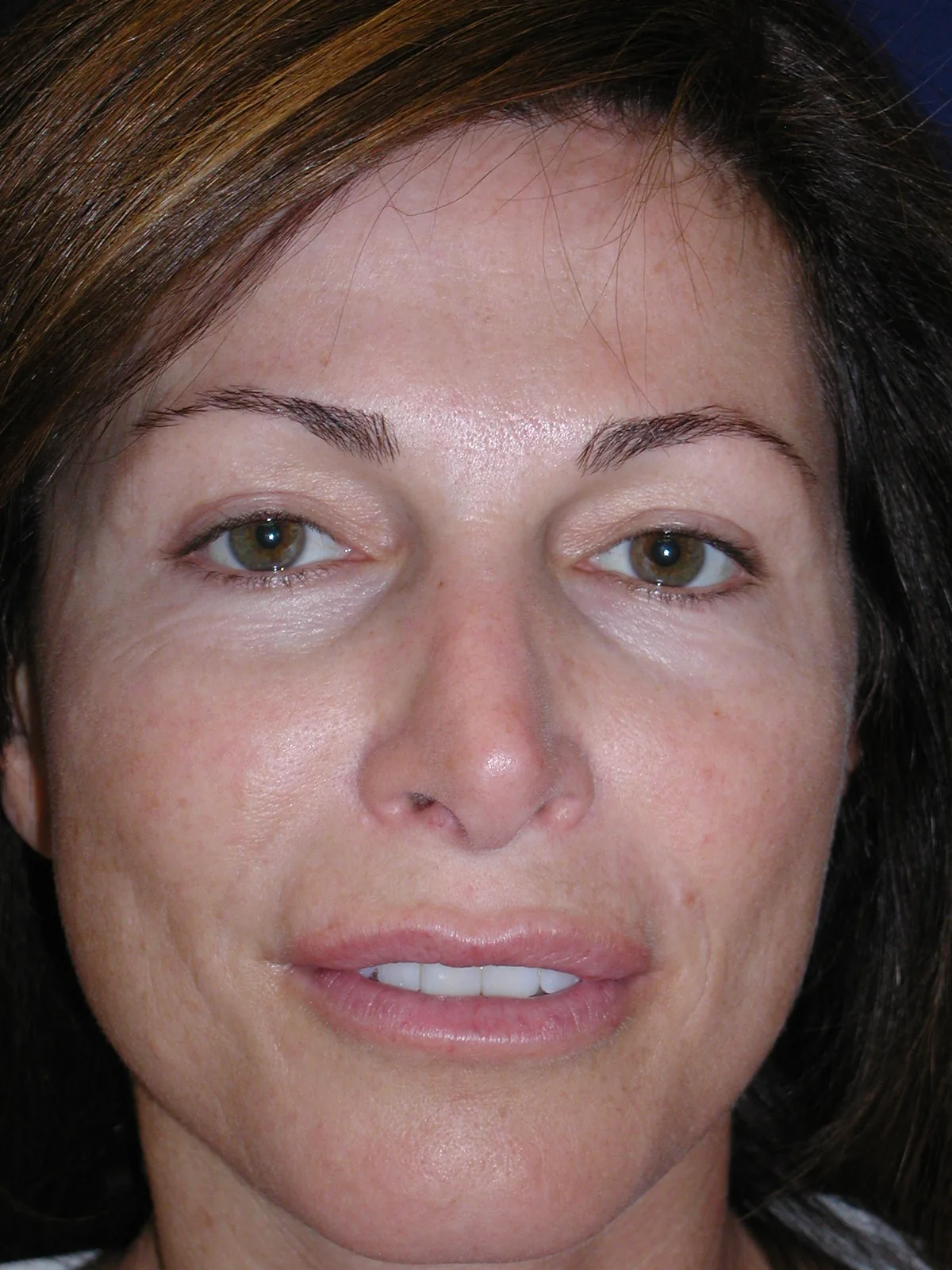 Before photo, front view &mdash; patient prior to combined eyelid rejuvenation, facial volume restoration, and carbon dioxide laser resurfacing in Las Vegas