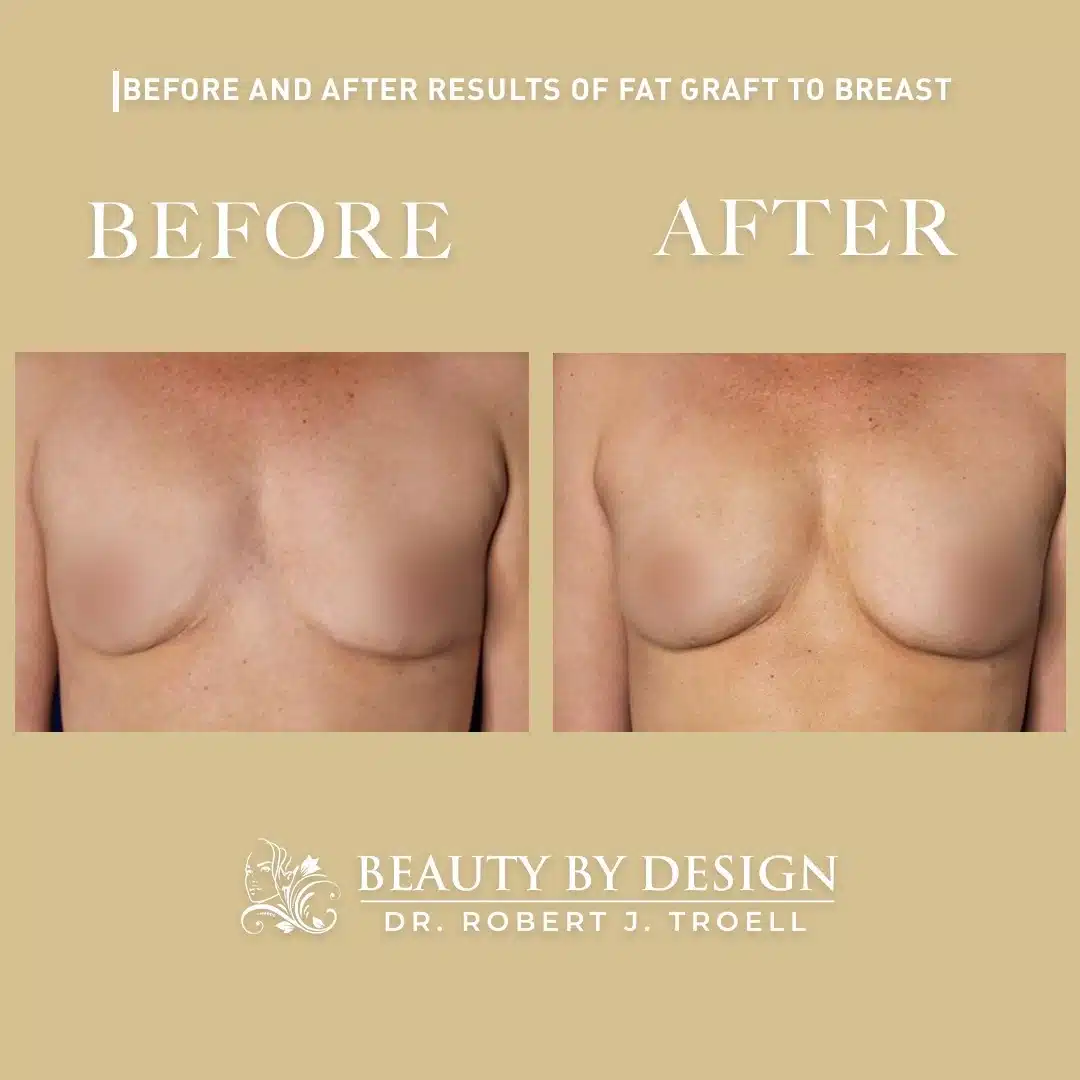 Fat transfer breast augmentation before and after, frontal view &mdash; a woman's breasts show fuller, natural-looking volume after natural breast augmentation with her own fat by Dr. Robert J. Troell in Las Vegas
