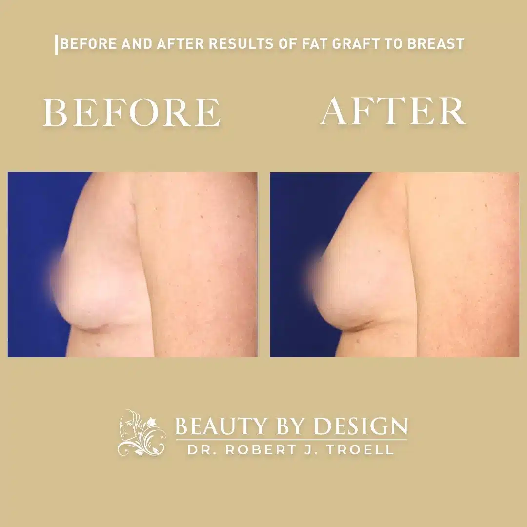 Fat transfer breast augmentation before and after, side profile &mdash; increased projection and a natural slope after breast fat transfer by Dr. Robert J. Troell in Las Vegas