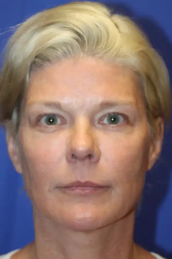 After full-face stem cell-enriched fat grafting, front view: restored midface and under-eye volume &mdash; actual patient, Las Vegas