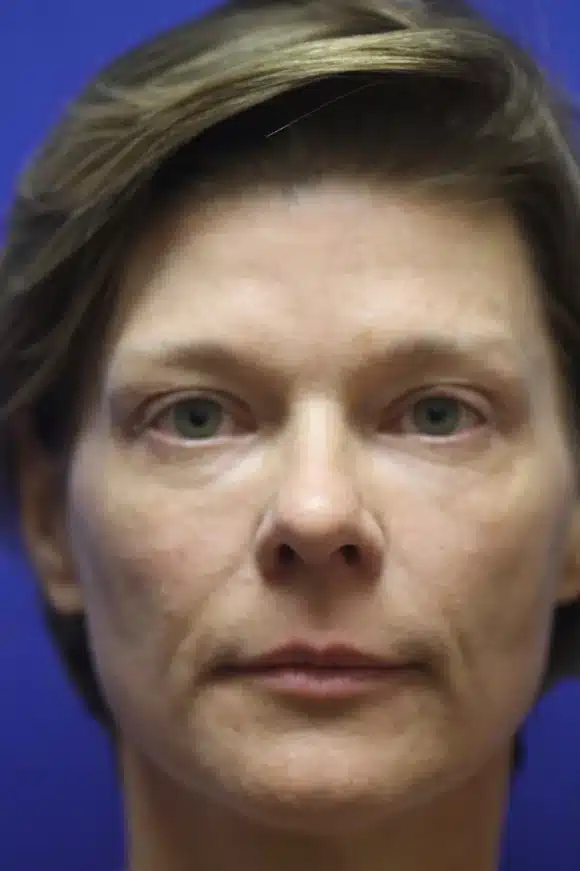 Before full-face stem cell-enriched fat grafting, front view &mdash; actual patient of Dr. Robert Troell, Las Vegas