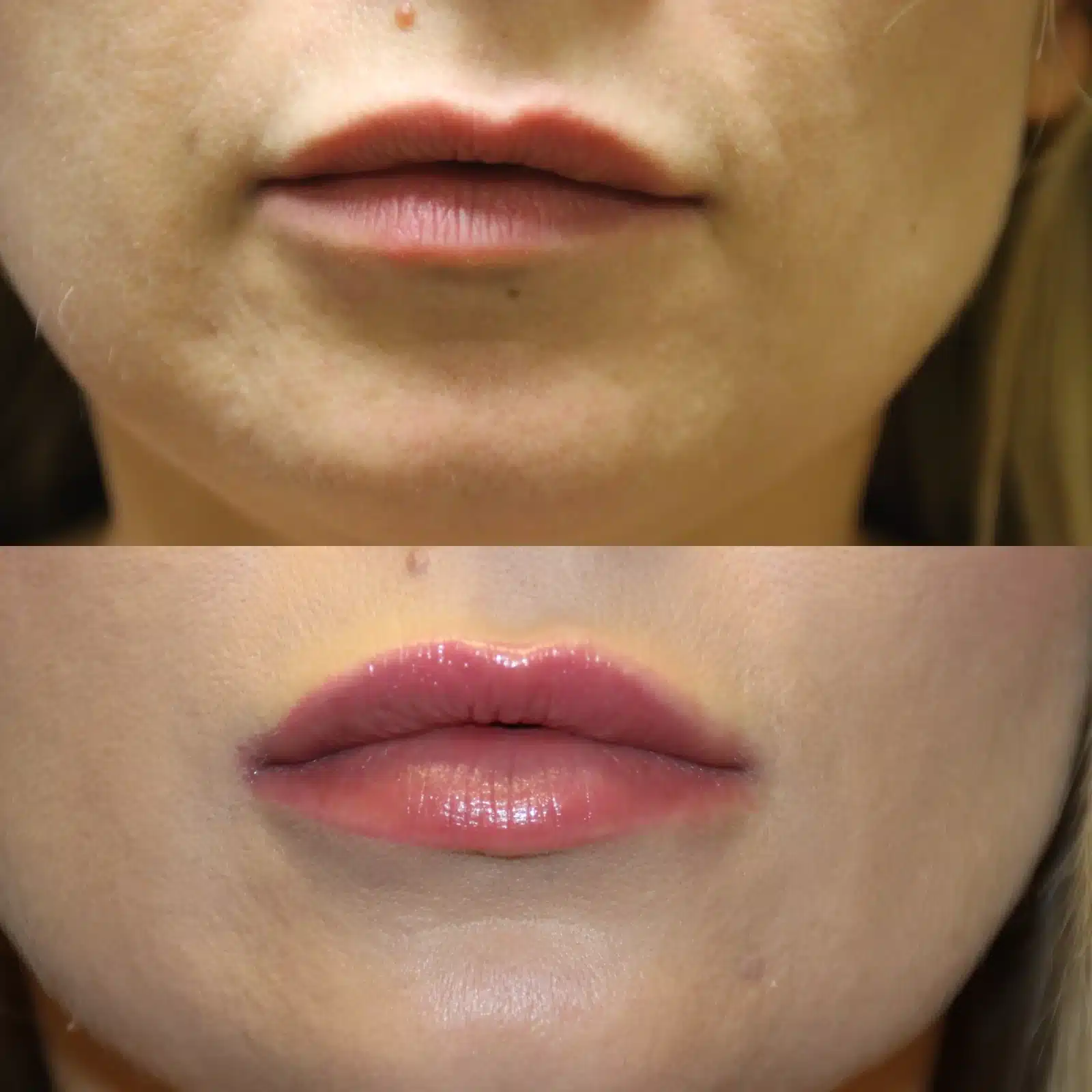 Before and after hyaluronic acid filler to the upper and lower lips, close-up &mdash; actual patient, Las Vegas