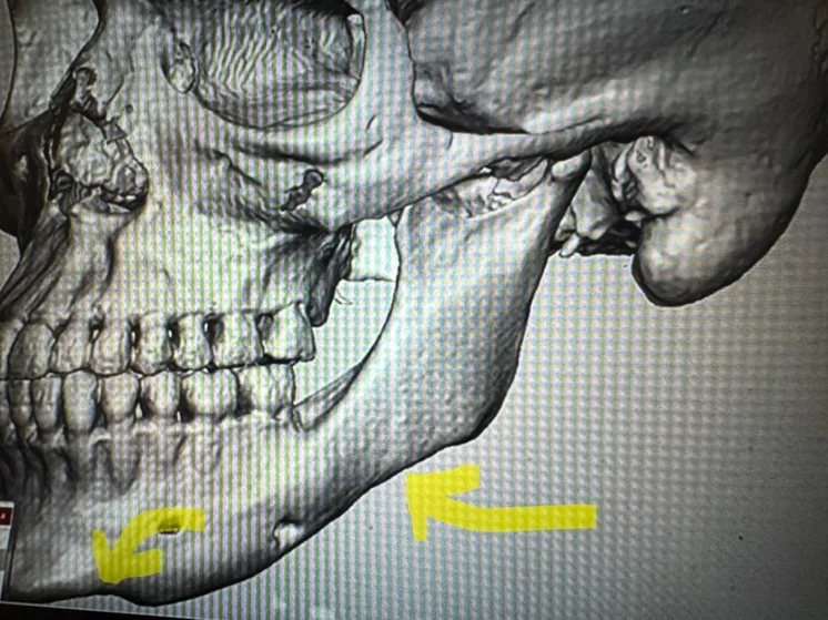 Three-dimensional maxillofacial CT reconstruction, lateral view, with arrows marking the mandibular contour deficiency a custom jawline implant is designed to correct