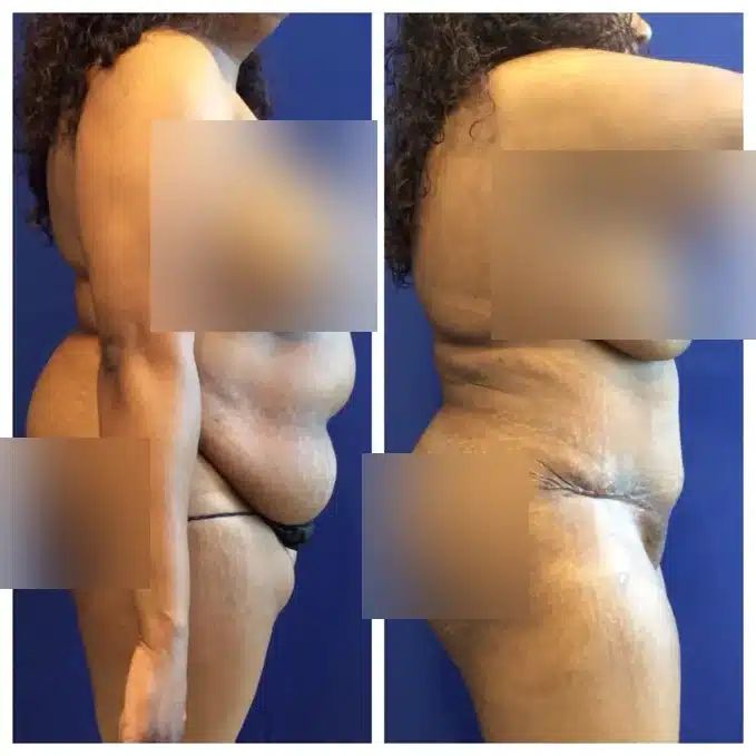 Before and after lipoabdominoplasty, side profile: the abdominal apron flattened after modified tummy tuck &mdash; actual patient, Las Vegas