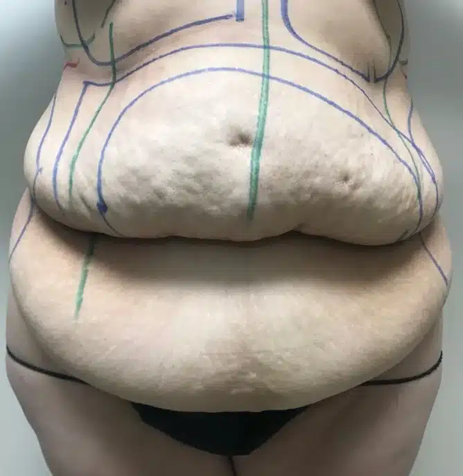 Pre-operative surgical planning markings on a female patient's abdomen before lipoabdominoplasty &mdash; Troell Cosmetic Surgery, Las Vegas