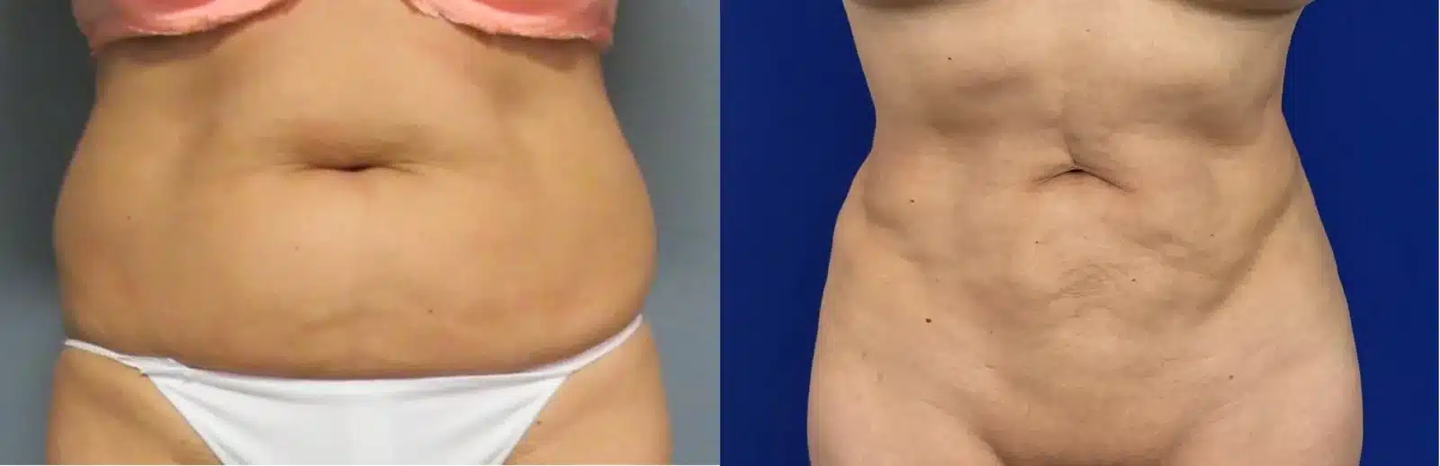 Liposuction body contouring before and after, front view &mdash; Patient 7