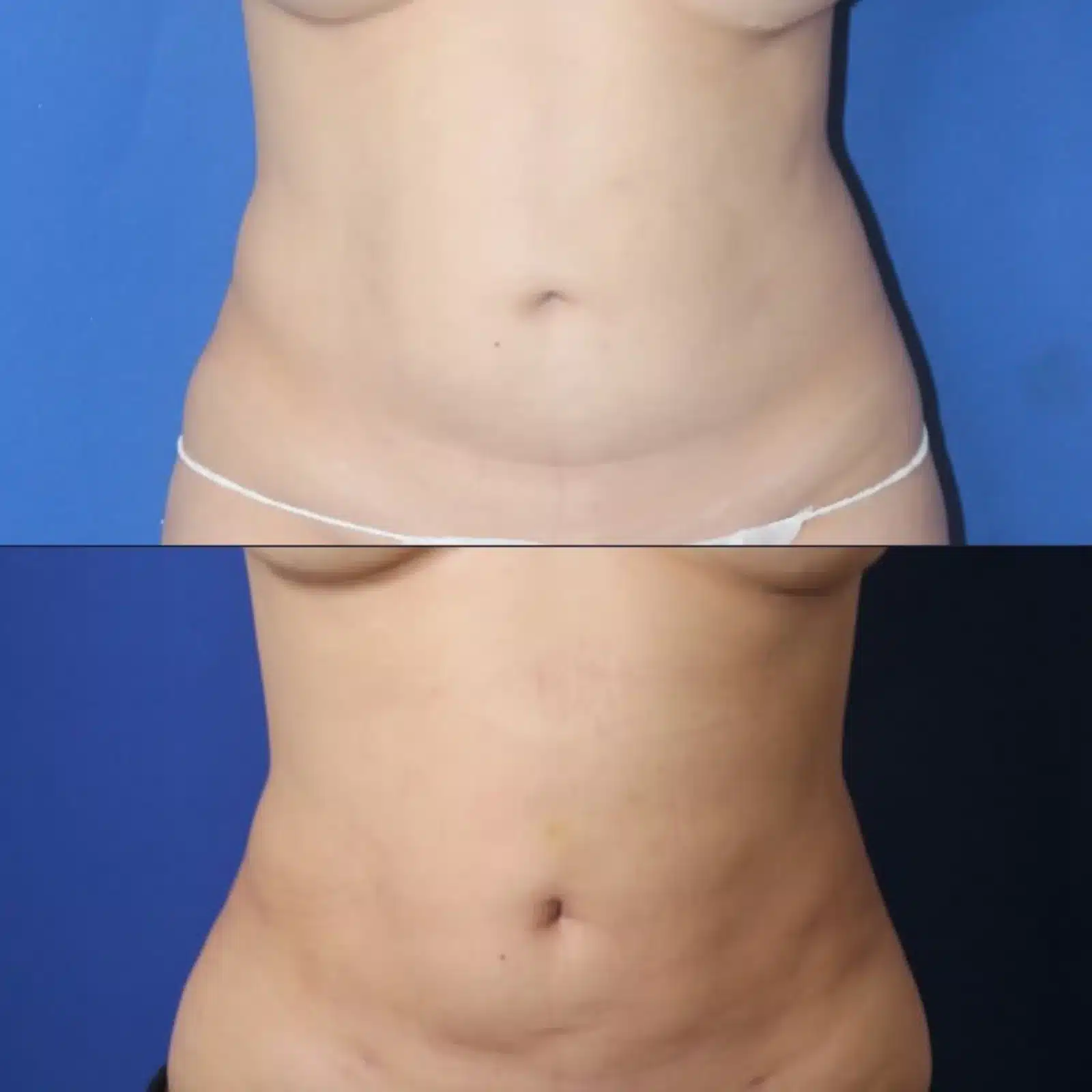 Liposuction before and after, front view &mdash; abdomen is flatter and the waistline more defined after liposuction by Dr. Robert J. Troell in Las Vegas