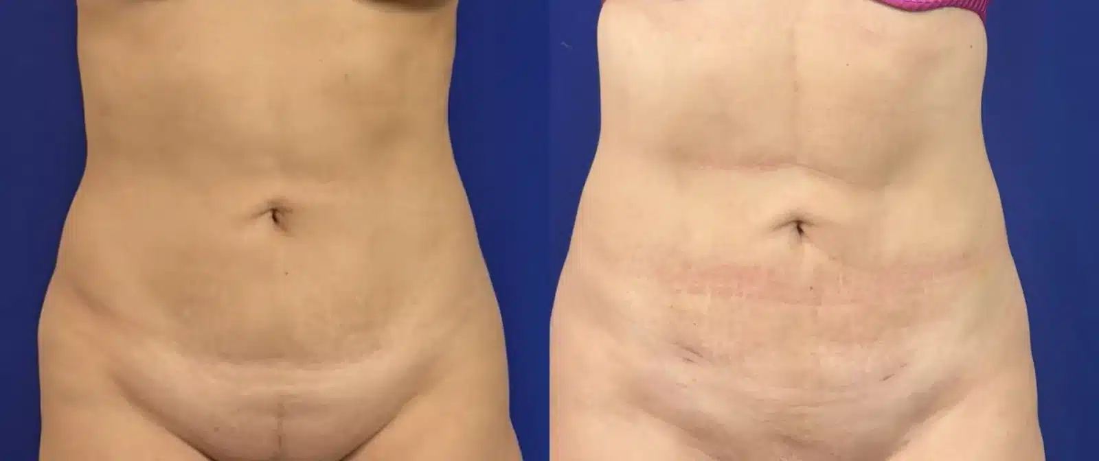 Liposuction body contouring before and after, front view &mdash; Patient 6