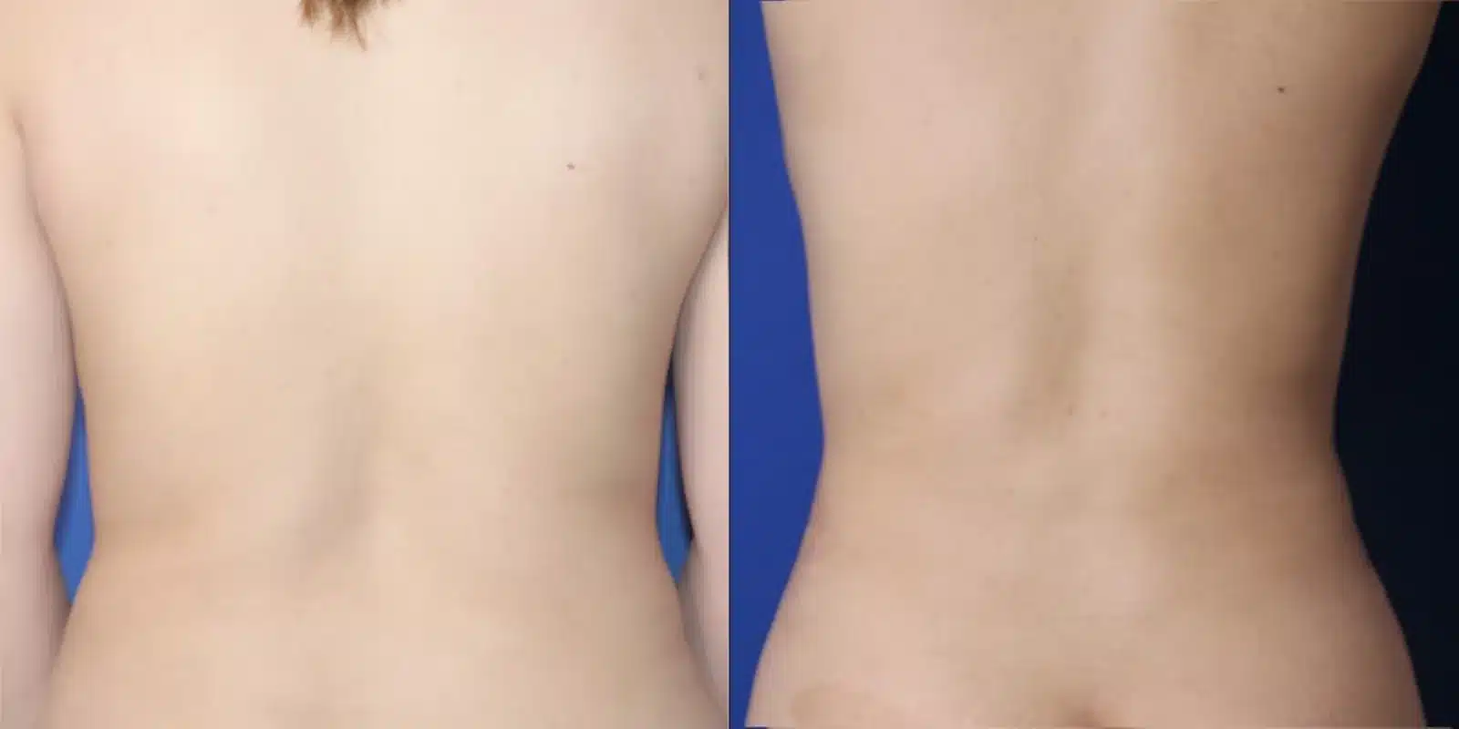 Liposuction before and after, back view &mdash; the back and flanks are smoother and more tapered after liposuction by Dr. Robert J. Troell in Las Vegas