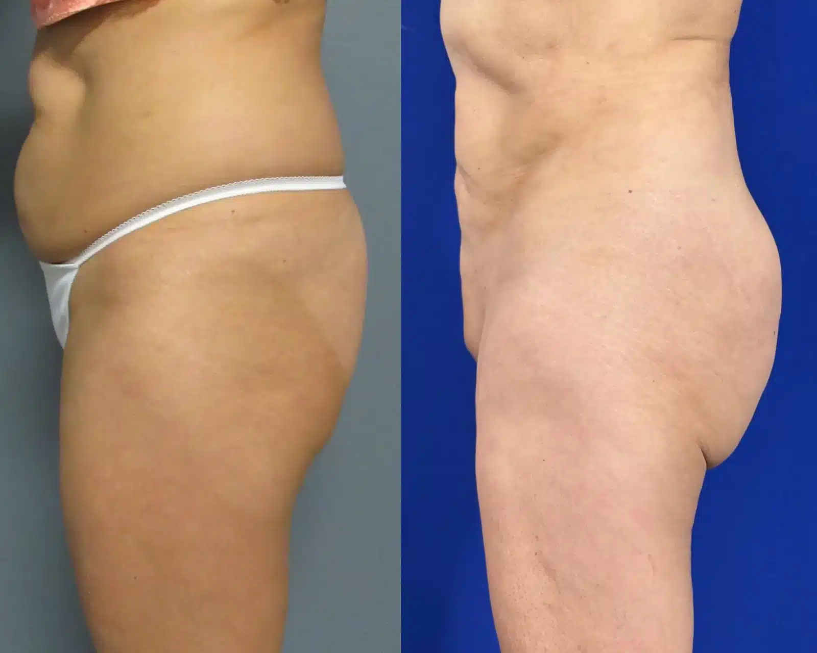 Body contouring before and after, oblique view &mdash; the hip and outer thigh contour is smoother after liposuction by Dr. Robert J. Troell in Las Vegas