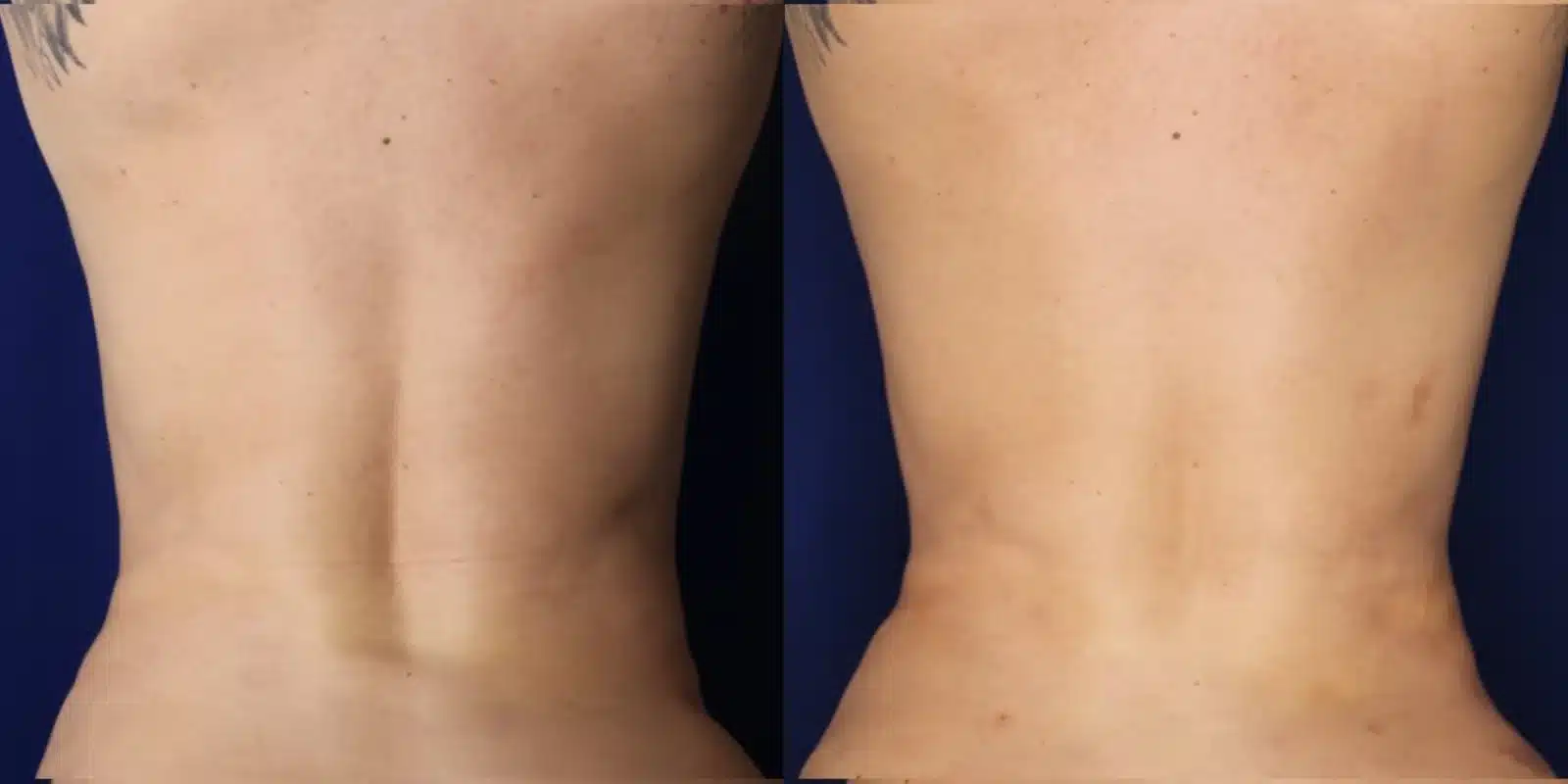 Liposuction body contouring before and after, back view &mdash; Patient 11